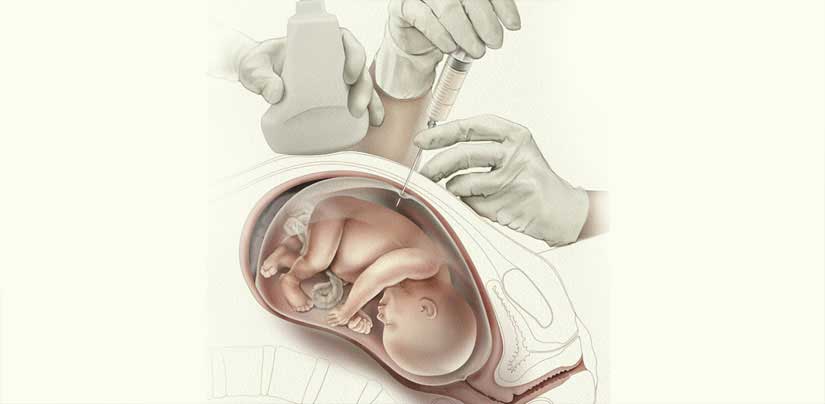 amniocentesis in kolkata