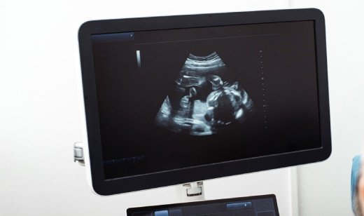 Fetal Echocardiography-complicated Fetal Echocardiography-complicated
