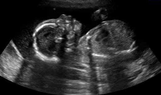 2D Ultrasound | Fetomat