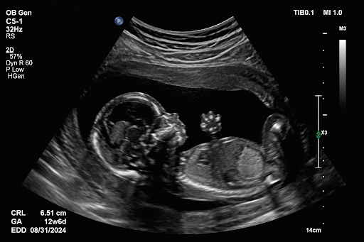What is pregnancy ultrasound
