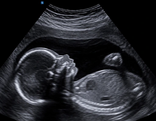 Why Growth Scans Matter After the First Trimester